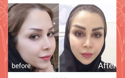 بهترین دکتر برای کاشت ابرو
