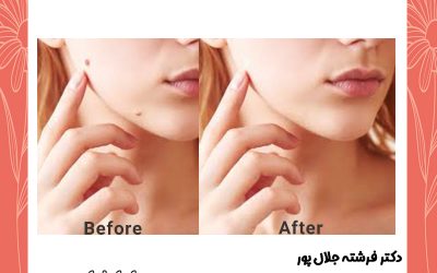 برداشتن خال گوشتی صورت بدون درد و خونریزی