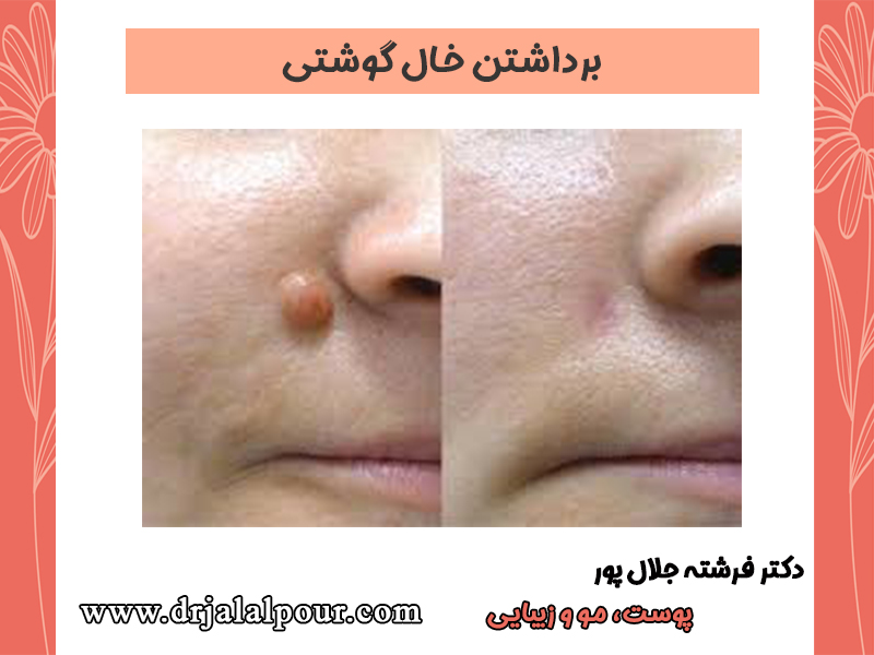 برداشتن خال گوشتی توسط دکتر فرشته جلالپور