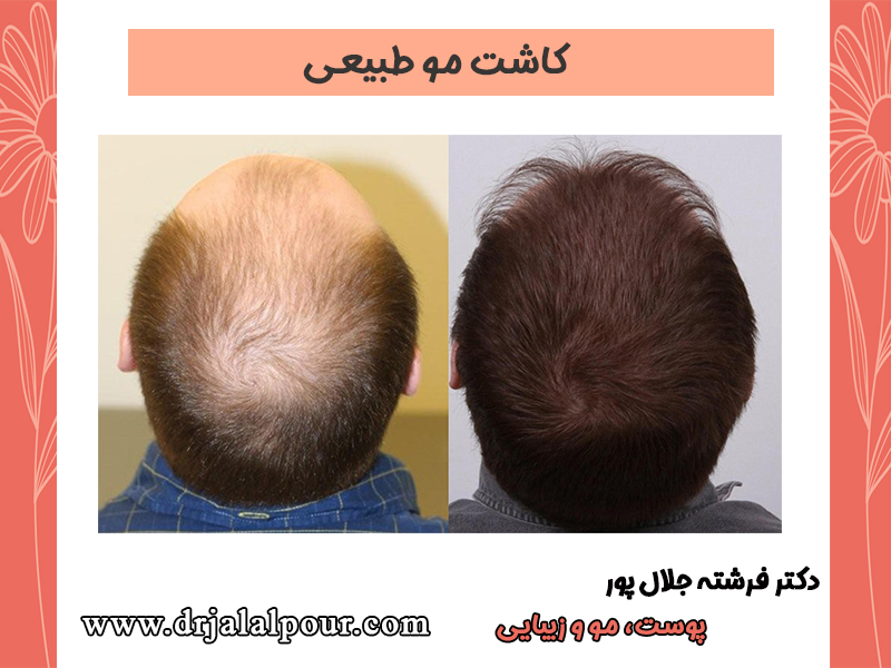 کاشت موی طبیعی چیست
