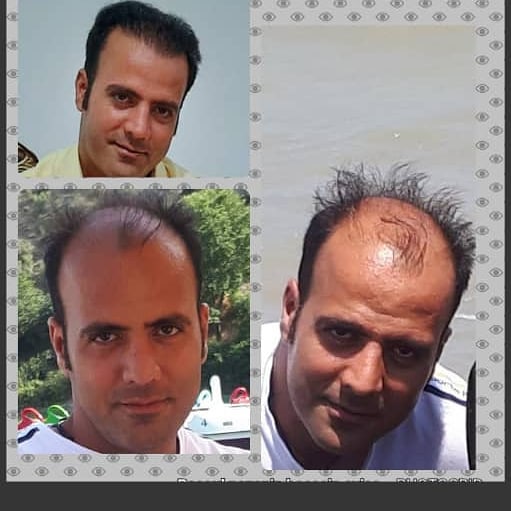 نمونه کاشت مو دکتر جلالپور