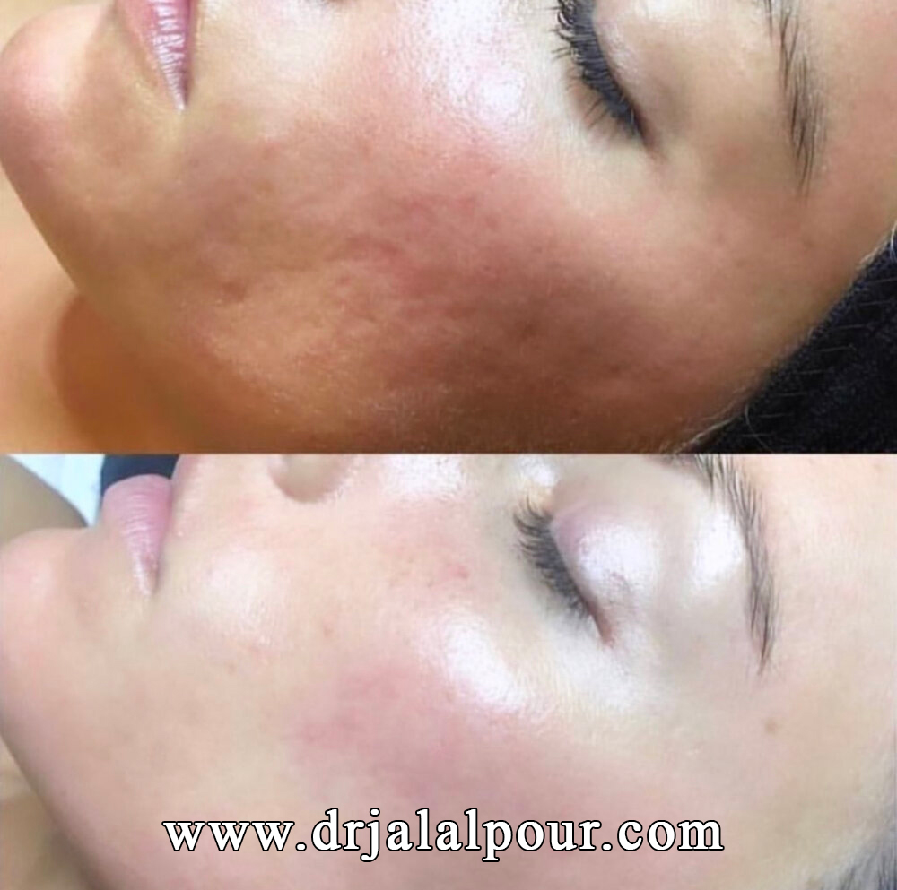 جوانسازی صورت با میکرونیدلینگ