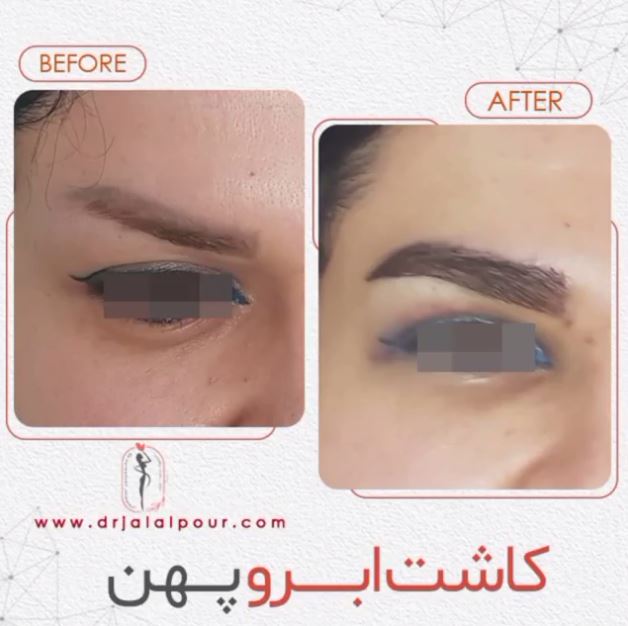 کاشت ابروی پهن