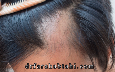 با ریزش مو چه کار باید کرد؟