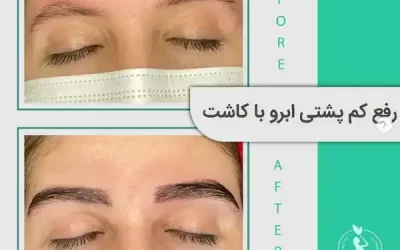 کاشت ابرو طبیعی| عوارض کاشت ابرو | فیلم کاشت ابرو