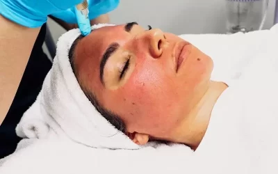 روش های از بین بردن لکه های پوستی