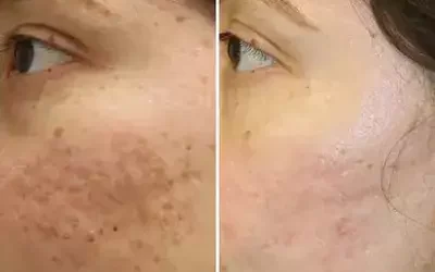 سابسیژن قطعی ترین درمان برای رفع لکه های پوستی و جای جوش