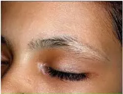 ترمیم شکستگی ابرو