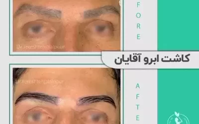 همه چیز درباره کاشت ابرو مردانه