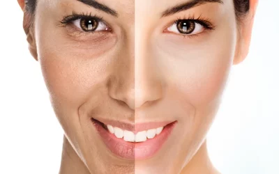 هایفوتراپی دور چشم+مزایا