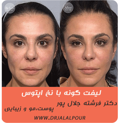 لیفت گونه با نخ های Aptos