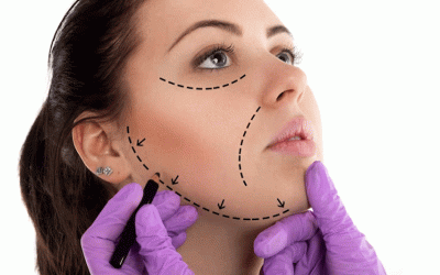 لیفت غبغب با نخ؛ همه آنچه قبل و بعد از عمل باید بدانید!