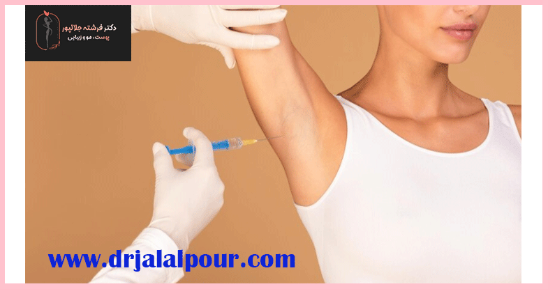 روش بوتاکس زیر بغل