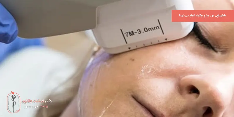 هایفوتراپی دور چشم چگونه انجام می شود؟